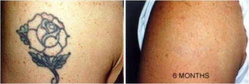 Tattoo Destroyer - Tattoo Removal Cream