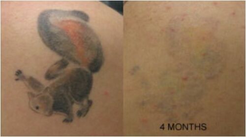 Tattoo Destroyer - Tattoo Removal Cream