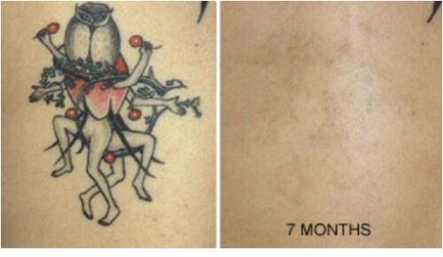 Tattoo Destroyer - Tattoo Removal Cream