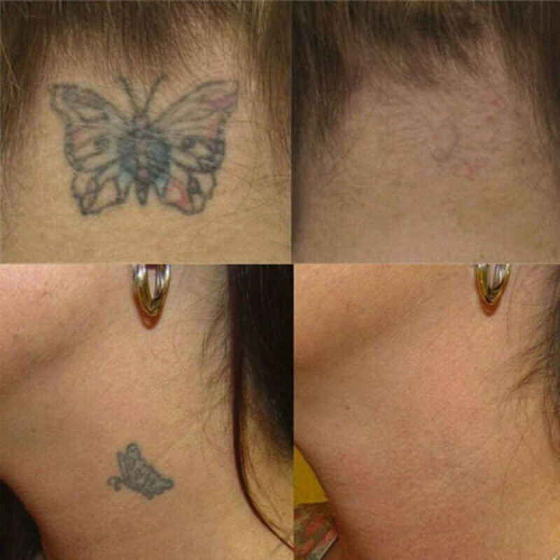 Tattoo Destroyer - Tattoo Removal Cream